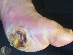 A patient with poorly controlled diabetes presents with an ulcer. What is the cause?