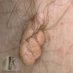 An older, obese person with T2DM develops a skin coloured polyp in the skin folds of the neck. What is this?