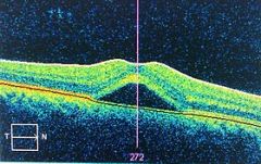 Central serös retinopati
Vätska läcker in under makula. Idiopatiskt. Går ofta tillbaka inom 3 månader. Eventuellt NSAID och steroider. Näthinneavlossning måste uteslutas. 