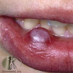 A patient presents with a lump on their lip, which appeared post traumatically biting their lip. What is it?