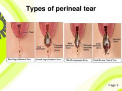 classification of perineal tears: