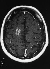 1. Venous angiomas or devlopmental venous anomalies are thin-walled venous structures with normal intervening brain tissue. They are asymptomatic with a very low risk of hemorrhage.


2. It has a caput medusa pattern. 


3. Capillary telangiectasi...