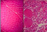 What has happened to the myocytes on the right if the myocytes on the left are normal