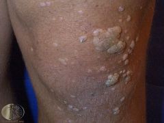 A child present with a skin coloured lump which has a rough surface on their knee. What is this condition?
