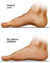 "flat foot"
loss of the medial longitudinal arch
low arch w/ feet that are pronated