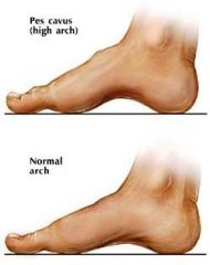 hollow foot

refers to an abnormally high medial longitudinal arch

high arch w/ feet that are supinated