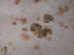 A 40 year old presents with a new warty spot on their back. What is this lesion?