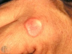 A diabetic patient develops lumps on the sides of their fingers, they are firm papules in a string of pearls pattern. What is this condition?