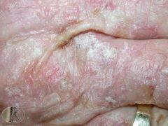 An elderly patient presents with this dry, rough, scale on her hand. What is this condition?