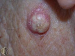Starts at the site of a minor injury to sun damaged and hair-bearing skin. Initially like a boil, but then grows rapidly and it may be up to 2cm in diameter. What is this?