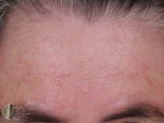 An elderly patient presents with small, yellow bumps on his forehead, a central hair follicle with yellow lobules surrounding. What is this condition?