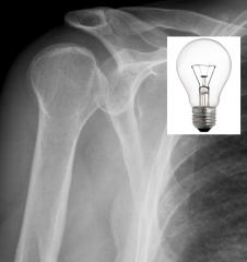 Patient complains of pain in the shoulder. XR reveals light bulb appearance. Likely diagnosis