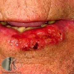 An elderly man, who is a smoker, and has spent a lot of time outdoors, presents with this scaly, crusted lump on his lip, what is it?
