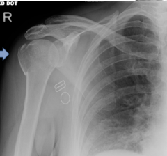 What complication of shoulder dislocation is demonstrated?