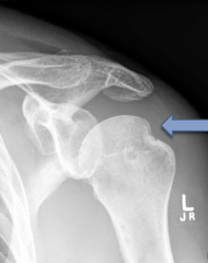 What complication of shoulder dislocation is demonstrated?