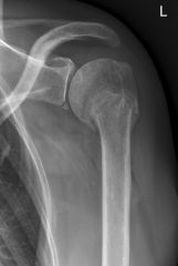What complication of shoulder dislocation is demonstrated?