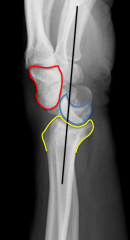 Capitate dislocated wrt lunate but lunate-radius articulation is intact.

Red: Capitate
Blue: Lunate
Yellow: Radius