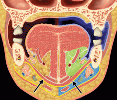 The mylohyoid muscle (arrows) acts like a sling to divides the submandibular space into a sublingual (green; infections anterior to 2nd molar) and submaxillary (light blue; infections of 2nd and 3rd molars) compartments