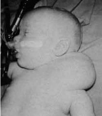 This baby has been affected with which disorder?