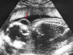 The red arrow is pointing to a cyst growing behind the head of this fetus, which is characteristic of which disorder?