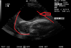 The red arrow is pointing to an enlarged nuchal translucency with an enormous cyst growing behind this fetus's head. This is characteristic of which disorder?