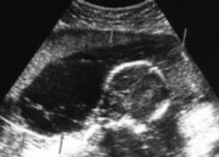 This fetus has septations within the _________________ developing behind the back of his head. This is characteristic of which disorder?