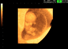 This image shows a fetus with a sac protruding through the base of its umbilical cord. This disorder is known as what?