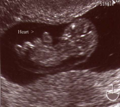 The heart on this fetus has developed outside of its body. This is an example of which disorder?
