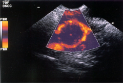 A ________________ is often seen when color doppler is turned on and placed around a gestational sac.