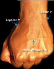 Basilic vein originates from dorsal venous arch of hand. The dorsal venous network lies beneath skin of the back of hand, superficial to extensor tendons.