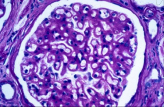 What kind of glomerular damage is shown here?