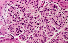 Glomerular damage of the type shown is associated with ____________ syndrome.