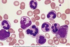 peripheral blood smear showing immature myeloid cells (with bands) is suggestive of what condition?