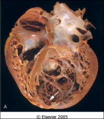 A large, heavy, floppy heart with mural thrombi as shown is characteristic of what?