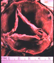 What abnormal valve is shown dilated here as a result of Marfan's disease