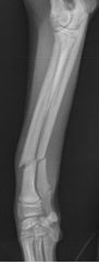 What is the orientation of this fracture?