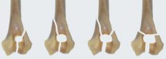 Name these condylar fractures (left to right)