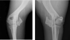 Names these 2 fractures