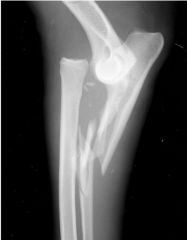 Name the fracture