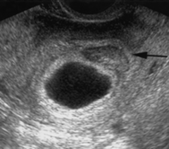 This image demonstrates an empty gestational sac. This is an example of which disorder?