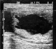 This image demonstrates an empty gestational sac with irregular walls. This is characteristic of which disorder?
