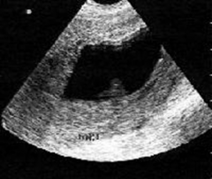 This image demonstrates a gestational sac with an embryo inside that has been confirmed to have no heartbeat. The body did not evacuate this fetus or it still has yet to evacuate it. This would be an example of what type of abortion?