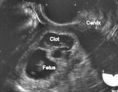 In this image, a developing fetus is seen within a gestational sac. A clot is also present near the gestational sac. This is an example of what type of abortion?