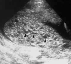 This image demonstrates the classical "bunch of grapes" sign. There is no gestational sac present within the uterus. This is an example of which type of molar pregnancy?