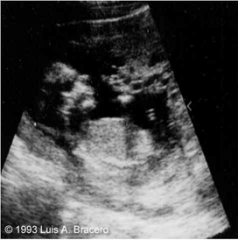This image demonstrates an abnormal fetus and abnormal placental tissue developing within this uterus. This is an example of which type of molar pregnancy?