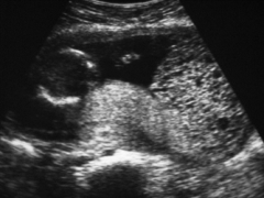This image demonstrates an abnormal fetus and abnormal placental tissue developing within this uterus. This is an example of which type of molar pregnancy?