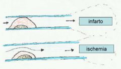 occlusione parziale: ischemia (angina,

claudicatio intermittens)




occlusione totale: infarto (necrosi, gangrena)
