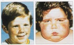 a group of symptoms caused by excess cortisol either from exogenous or endogenous sourcessymptoms include: slow growth with pubertal arrest, "moon" facies, central obesity, abdominal striae, acne, hirsuitism, facial flushing, hyperpigmentation, hy...