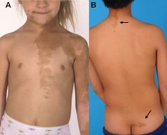 a genetic disease that consists of precocious puberty, cafe au lait spots, and polyostotic fibrous dysplasia