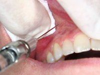 Injection site


 


Mesial to the maxillary canine, at the apex, in the muccobucal fold.